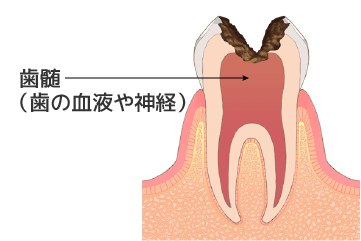 C3：神経に達する虫歯