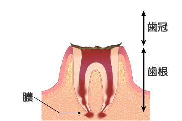 C3：歯根に達する虫歯